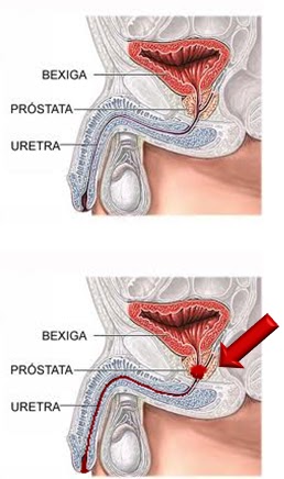 próstata de infección